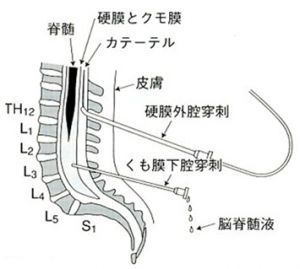 麻酔 オペ室ナースのためのブログ